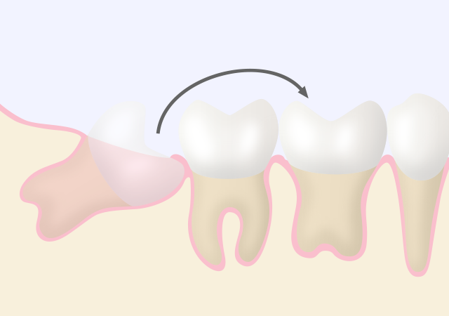 歯牙移植と歯牙再植